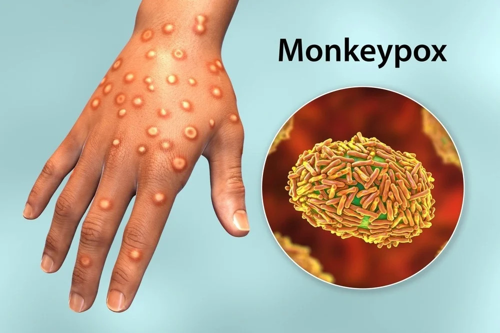 monkeypoxw.webp